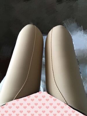 擺脫大粗腿做了大腿抽脂，煙臺鵬愛魏璐做的