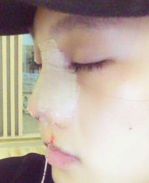 趙煜楠給做的隆鼻整形，看看我鼻子果怎么樣