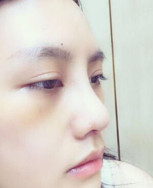 趙煜楠給做的隆鼻整形，看看我鼻子果怎么樣