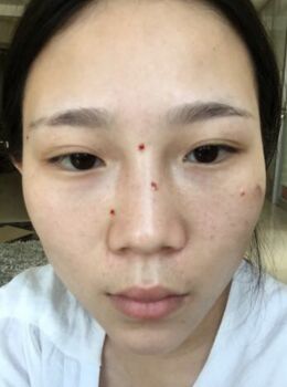 激光去雀斑后皮膚干凈白皙多了，青島華韓汪曉波做的