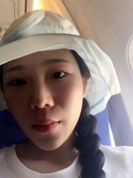 激光去雀斑后皮膚干凈白皙多了，青島華韓汪曉波做的