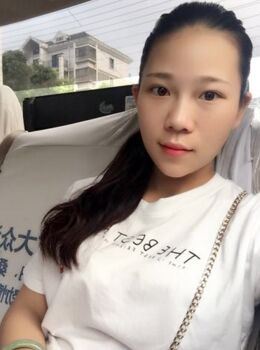 激光去雀斑后皮膚干凈白皙多了，青島華韓汪曉波做的