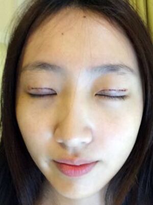 何賢清全切雙眼皮加去脂肪 果賊自然