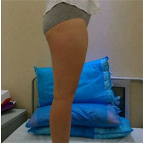 東方和諧馮斌做的大腿吸脂，給你們看看前后對(duì)比果圖片！