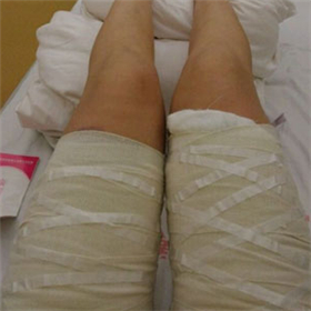 東方和諧馮斌做的大腿吸脂，給你們看看前后對(duì)比果圖片！