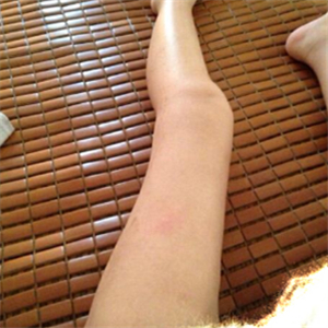 去東方和諧做了大腿抽脂，分享一下我的前后對(duì)比果圖片吧！