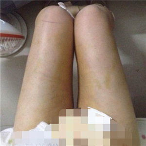 看看我大腿吸脂的前后對(duì)比果圖片吧，是東方和諧張準(zhǔn)做的