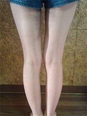 去年東方和諧張準(zhǔn)醫(yī)生做的大腿抽脂，分享一下我的前后對(duì)比果圖片！