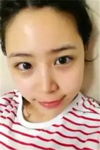 找夏正義做自體脂肪面部填充三個(gè)月了，恢復(fù)果很好有對(duì)比照片哦~~