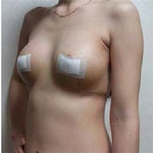 南昌同濟(jì)做的極速動(dòng)感微創(chuàng)豐胸術(shù)，分享下我的恢復(fù)過程圖片吧~