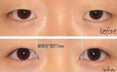 割雙眼皮和開(kāi)內(nèi)眼角前后對(duì)比圖