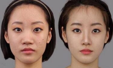 隆鼻+鼻翼縮小前后對(duì)比圖