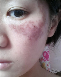 華美杜姜做的激光祛斑 果好不好你來看