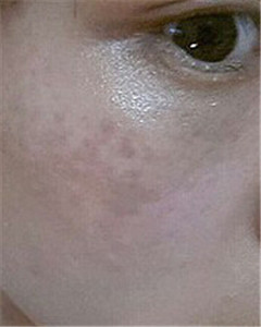 華美杜姜做的激光祛斑 果好不好你來看