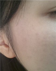 華美杜姜做的激光祛斑 果好不好你來看