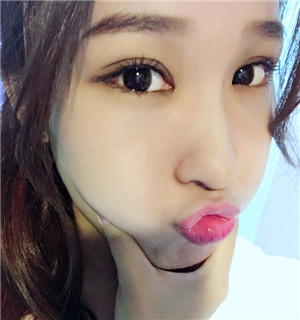 秦宏偉做的雙眼皮多項整形 丑小鴨的蛻變啊