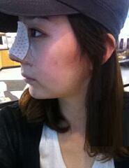 深圳希思崔院長(zhǎng)隆鼻整形 擺脫了豬妹妹的稱號(hào)