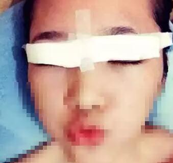 深圳希思做的雙眼皮 現(xiàn)在美美的