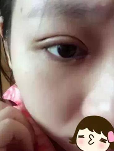 深圳希思做的雙眼皮+開眼角 感謝楊醫(yī)師！