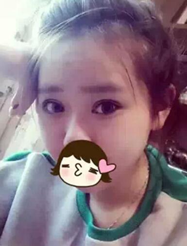 深圳希思做的雙眼皮+開眼角 感謝楊醫(yī)師！