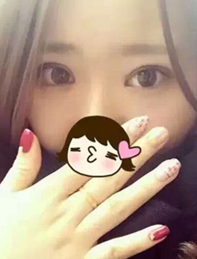 深圳希思做的雙眼皮+開眼角 感謝楊醫(yī)師！