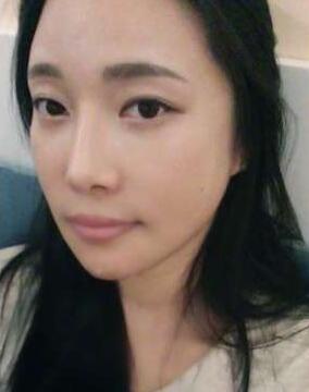 柳大烈給我做的改臉型手術 求圍觀！