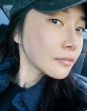 柳大烈給我做的改臉型手術 求圍觀！