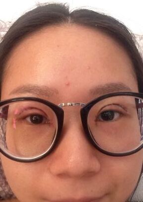全切雙眼皮改良了我的內(nèi)雙腫泡眼，多虧了何賢清醫(yī)生