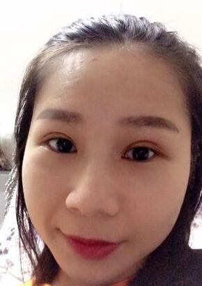 全切雙眼皮改良了我的內(nèi)雙腫泡眼，多虧了何賢清醫(yī)生