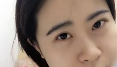 全切雙眼皮后眼形漂亮多了，安徽維多利亞徐和林做的喲