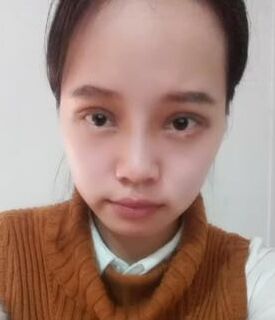 全切雙眼皮+去脂肪，終于擺脫小眼睛了