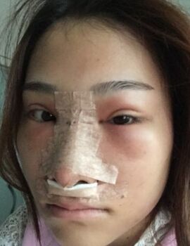 硅膠隆鼻還墊鼻尖了，甘泉涌做的果真的很好喲