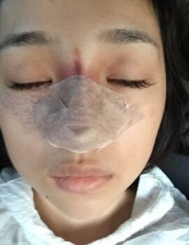 合肥楊鵬隆鼻整形真實(shí)案例分享