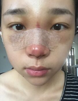 合肥楊鵬隆鼻整形真實(shí)案例分享