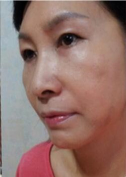 做了電波l皮除皺年輕了十多歲 杭州同欣做的很不錯哦