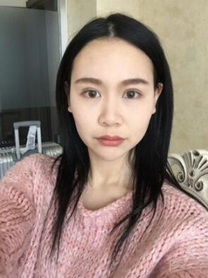 成都天使之翼做隆鼻整形改變了我的塌鼻子 果真的很不錯