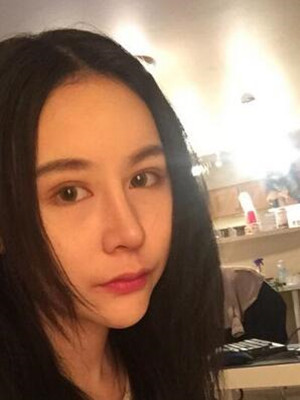 成都天使之翼做隆鼻整形改變了我的塌鼻子 果真的很不錯