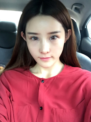 自體脂肪填充全臉后人生像開了掛