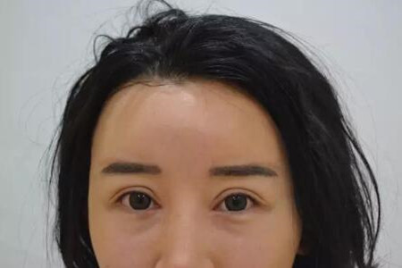 成都天使之翼做的雙眼皮修復怎么樣 快來圍觀