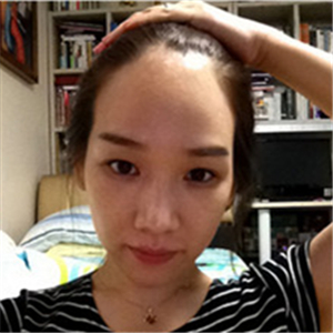 去年在格萊美做了頭發(fā)種植，看看前后對比和恢復果照片吧~~