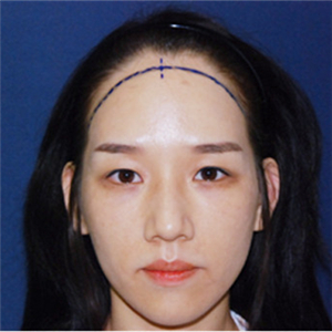 去年在格萊美做了頭發(fā)種植，看看前后對比和恢復果照片吧~~