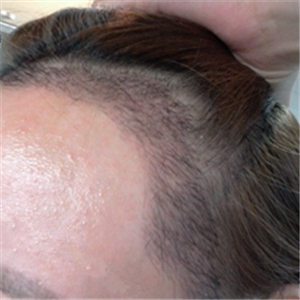 分享我頭發(fā)種植前后和恢復過程的圖片，是格萊美黃興勇做的哦~~~