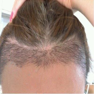 分享我頭發(fā)種植前后和恢復過程的圖片，是格萊美黃興勇做的哦~~~