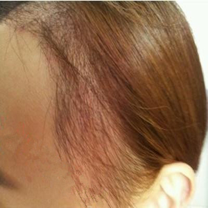 分享我頭發(fā)種植前后和恢復過程的圖片，是格萊美黃興勇做的哦~~~