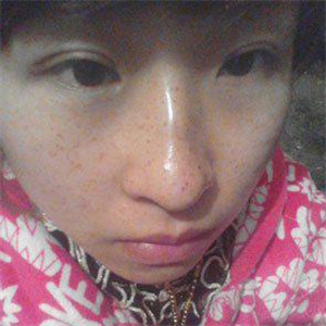 去格萊美做了激光去雀斑，有恢復(fù)前后的對(duì)比照片哦，還不錯(cuò)~~