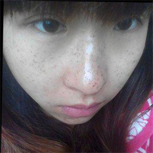 去格萊美做了激光去雀斑，有恢復(fù)前后的對(duì)比照片哦，還不錯(cuò)~~