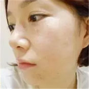 做了激光去雀斑前后對(duì)比照片分享，黃俊俊的技術(shù)很好哦！