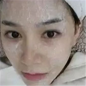 做了激光去雀斑前后對(duì)比照片分享，黃俊俊的技術(shù)很好哦！