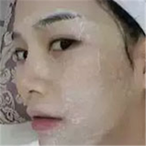 做了激光去雀斑前后對(duì)比照片分享，黃俊俊的技術(shù)很好哦！