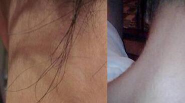 激光脫毛前后對比圖，8000元全身激光脫毛